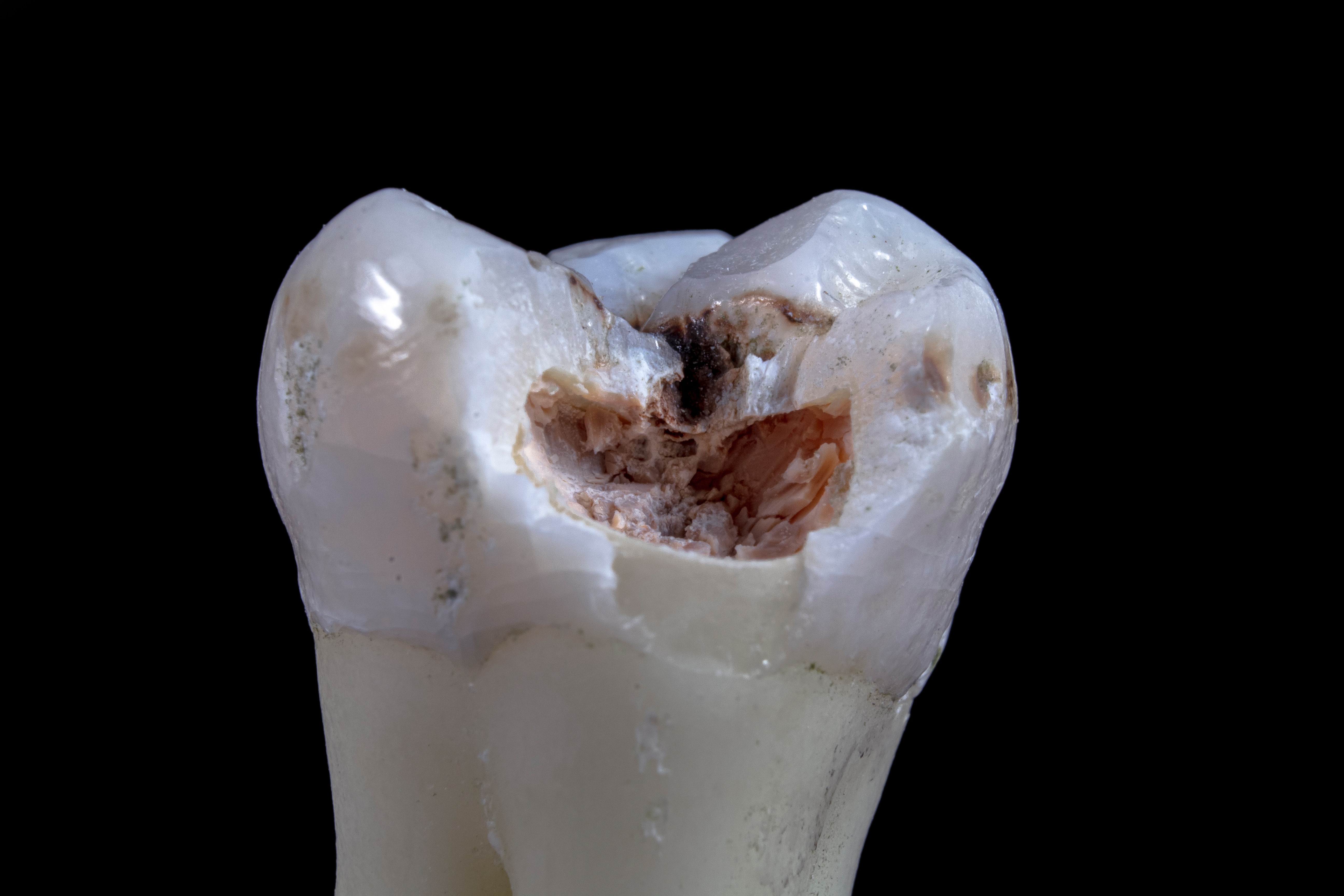 Причины и признаки деминерализации зубной эмали