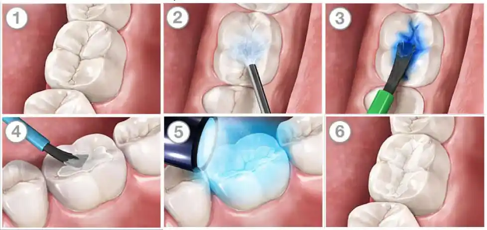 Процесс герметизации фиссур
