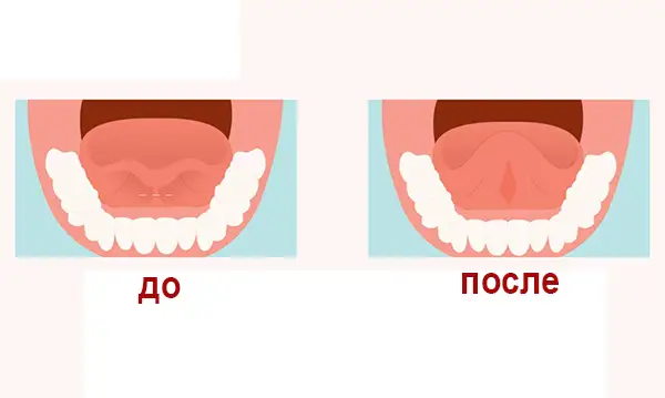 Показания к пластике уздечки
