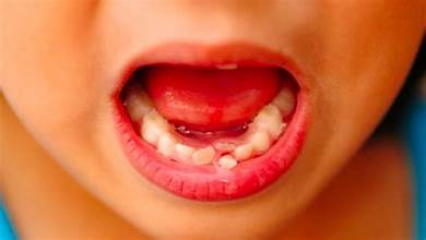 Как вырвать коренной зуб в домашних условиях без боли