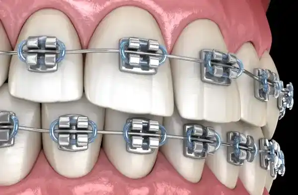 Металлические брекеты