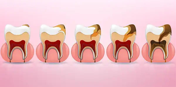 Диаграмма, показывающая глубокий кариес