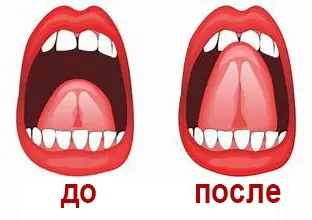 Уздечка языка