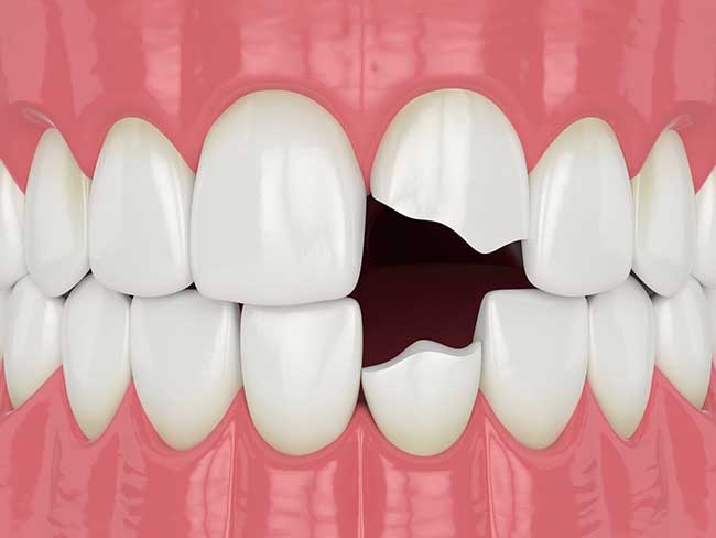 Скол зуба: причины и последствия