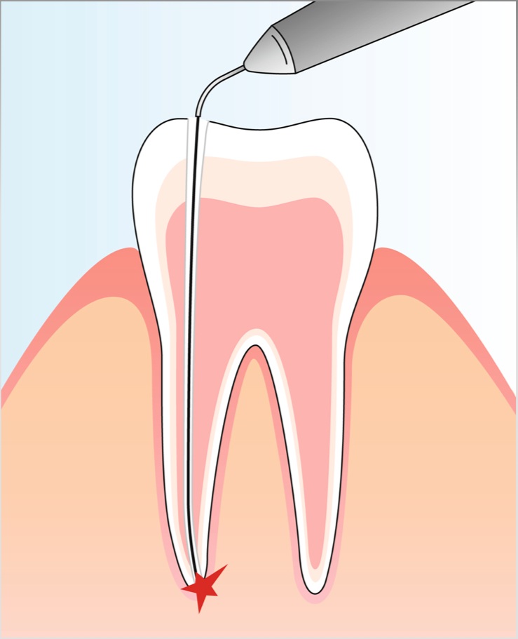 Операция кисты зуба