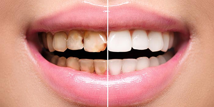 Что представляет собой современная реставрация зубов?